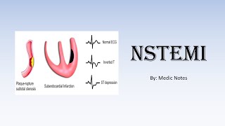 NSTEMI nonST elevation myocardial infarction  investigations management [upl. by Ahsenor]