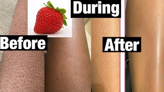 How to get rid of strawberry legs in 3 days with one cream [upl. by Hnirt]