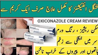 Xirconi cream uses in Urdu  oxiconazole nitrate 1 Benifits  xirconi cream  dosage sideeffects [upl. by Silvano]