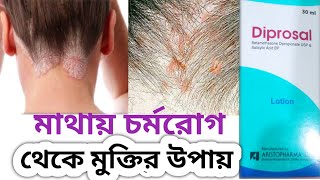 Diprosal lotionquotমাথার এলার্জি থেকে মুক্তির সহজ উপায়। [upl. by Eycats502]