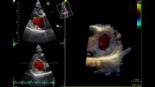 3D echocardiogram in a dog 7 kg with MR（犬の僧帽弁逆流の３Dエコー） [upl. by Cid427]