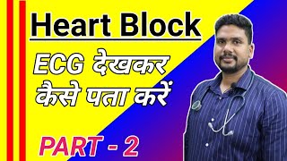 ECG in heart block 1st degree 2nd degree Mobitz type 1 type 23rd degreecomplete heart block [upl. by Beshore]