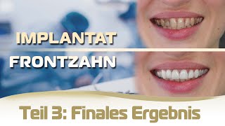 Implantat einsetzen Frontzahn Ablauf Teil 3  Finales Ergebnis mit festem Zahnersatz Vorher Nachher [upl. by Ernesta]