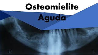 Osteomielite Aguda  Odontologia  Dra Bianca Rosa [upl. by Tillio]