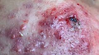 CYSTIC ACNE REMOVAL  Inflammatory Acne Acne Skin Treatment [upl. by Horatius821]