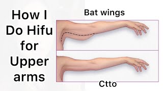 PART 2  Hifu for the Upper Arms  Self Treatment of Bat Wings sagging skin [upl. by Dalia]