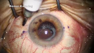 IOL Exchange and intrascleral haptic fixation with Yamane technique using 27 gauge needle [upl. by Anitnatsnoc]