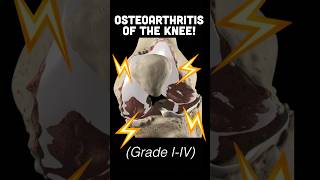 Doctor Explains Knee OSTEOARTHRITIS Grade IIV 🦴 [upl. by Wilde]