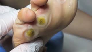 Pedicure video30，vertical plantaris，plantar wart [upl. by Auhso]