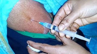 IM Injection Video Dexamethasone injection push 24 Ep 41 By Injection Media [upl. by Peh]