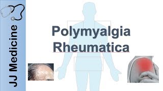 Polymyalgia Rheumatica  Signs amp Symptoms Diagnosis and Treatment [upl. by Celene]