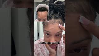 3 months using Minoxidil 💕 alopecia minoxidil hairlosstreatment alopeciahairloss walmart [upl. by Hamid]