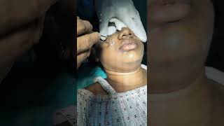 laser mole removal on face by Dr gopal krishna MD cosmos laser hospital vizag Hyderabad 8008112111 [upl. by Ybeloc183]