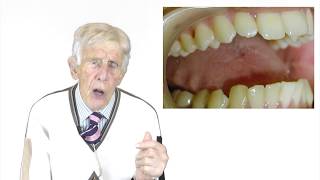 Tongue Splinting By Prof John Mew [upl. by Cos]