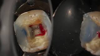 Complete endodontic treatment of a lower first molar step by step [upl. by Bronez]