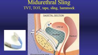 Stress Urinary Incontinence Evaluation and Treatment [upl. by Fuld]