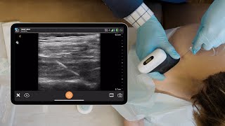 Ultrasound Anatomy of the Proximal Suprascapular Nerve [upl. by Llorrac424]