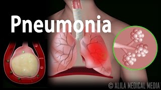 Pneumonia Animation [upl. by Treharne704]