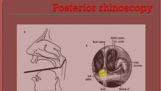 ENT LECTURES  Nasal polyp  ANTROCHOANAL POLYP [upl. by Erving]