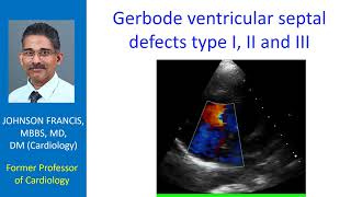 Gerbode ventricular septal defects type I II and III [upl. by Nessim]