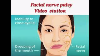 Facial nerve palsy mrcpch Video station [upl. by Lehcar]