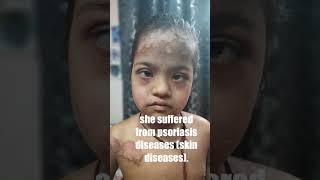 A psoriasisskin disease patients testimony yanungjamohlegoherbal [upl. by Deryl982]