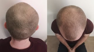 Pumpkin Seed Oil for Hair Loss 24 Week Experiment [upl. by Nonrev]