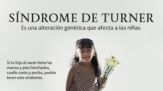 El Sindrome de Turnersindrome q afecta Ninas [upl. by Blinni]