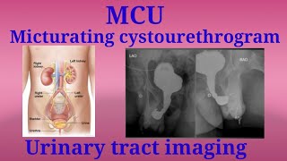 MCU Procedure  Micturating Cystourethrogram  Urinary tract imaging  By BL Kumawat [upl. by Alonso905]