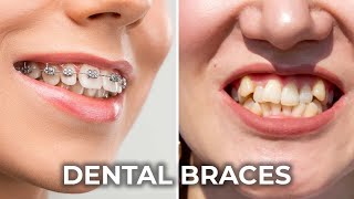 Transform Your Smile  A Comprehensive Guide to Dental Braces Treatment [upl. by Nwahsud872]