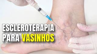 Escleroterapia secagem de vasinhos aplicações nas varizes laser e esclero [upl. by Dodi]