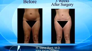 Tummy Tuck or Abdominoplasty with Plastic Surgeon Dr Steve Byrd [upl. by Thedric]