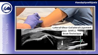 Lateral Ulnar Collateral Ligament of Elbow Scan Technique [upl. by Kerman824]