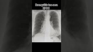 BRONQUITIS TOS SECA EPOC [upl. by Valora]