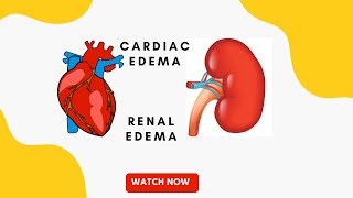 Cardiac edema vs renal edema  pathology  MBBS 2nd year [upl. by Aihsyn]