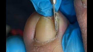 Huge ingrown toenail removal [upl. by Bellis693]