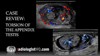 Ultrasound of Torsion of the Appendix Testis [upl. by Chimene670]