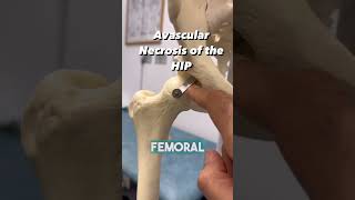 HOW DO YOU GET BONE NECROSIS OF THE HIP [upl. by Aliek]