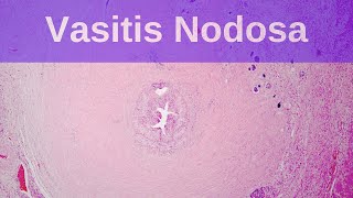 Vasitis Nodosa  Pathology mini tutorial [upl. by Emmit]