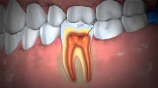 Treatment of Abscessed Teeth [upl. by Aprile]