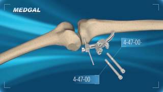 Tibial Osteotomy TECHNIQUE [upl. by Honorine923]