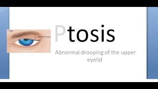 Ophthalmology 388 a Ptosis Congenital Types Classification Definition What is Define Classify [upl. by Notnert]