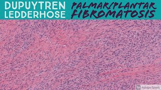 Palmar Fibromatosis Dupuytren Contracture amp Plantar Fibromatosis 5Minute Pathology Pearls [upl. by Moule860]