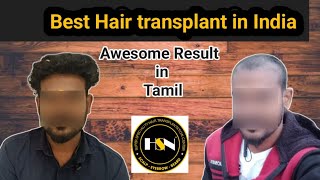 Hair Transplant result in Tamil  Awesome result  besthairtransplantinsouthindia hsn [upl. by Anigger386]