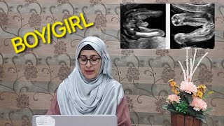 How to tell gender on ultrasound  Placenta Previa mean BoyGirl  Posterior Placenta means BoyGirl [upl. by Ayahs]