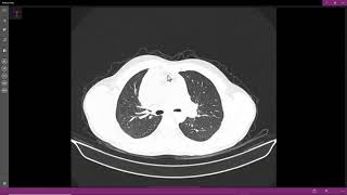 Teratoma mediastinal [upl. by Yenahpets708]