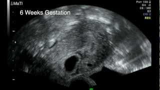 Early Pregnancy scan  Cesarean Scar Pregnancy Video 1 [upl. by Eelarak]