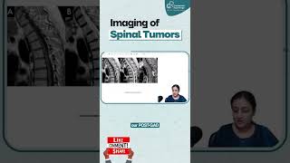 Imaging of Spinal Tumors By Dr Zainab Vora  Radiology Residency  Conceptual Radiology [upl. by Notlrac]