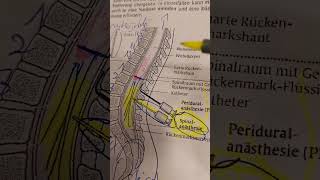 Querschnittslähmung durch Spinalanästhesie [upl. by Kepner732]
