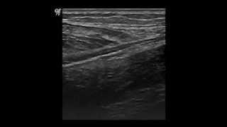 Gastrocnemius Tear  QMH AED Ultrasound Casebook 201205 [upl. by Hyps]